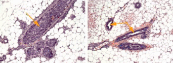 Imagen: Los conductos galactóforos de ratones propensos al cáncer están llenos de células tumorales (células de color morado oscuro, que se muestran con una flecha), haciendo que los conductos sean más gruesos. Sin embargo, los conductos galactóforos de los ratones tratados con una nanopartícula para el silenciamiento génico permanecen huecos en su mayoría (a la derecha, mostrados por las flechas), como los conductos sanos (Fotografía cortesía de la Dra. Amy Brock, Facultad de Medicina de la Universidad de Harvard).