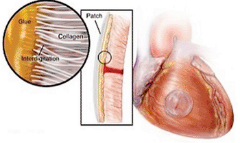 Imagen: Pegamento quirúrgico resistente a la sangre HLAA (Fotografía cortesía de Gecko Biomedical).