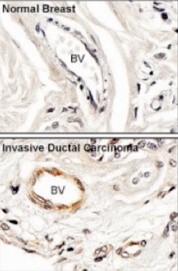 Imagen: El tejido mamario normal y un carcinoma ductal invasivo teñido de color marrón con anticuerpos contra la FAK activada. Los vasos sanguíneos se indican como BV (Fotografía cortesía del Dr. David Schlaepfer, Universidad de California, San Diego).