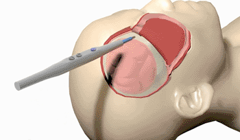 Imagen: El procedimiento de craneoplastia de incrustación pericraneal incluye retirar solo las tres capas superiores de las cinco capas del cuero cabelludo, lo que permite intercalar el hueso o el implante entre las capas (Fotografía cortesía de la revistaNeurosurgery Journal).