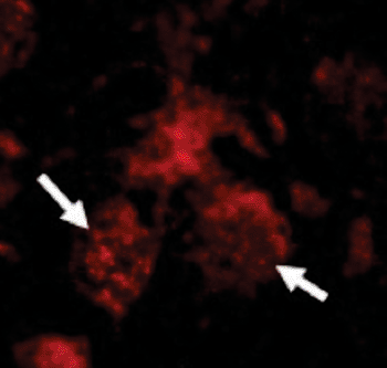 Imagen: La elevación del RIPK3 en los núcleos de las neuronas (rojo, flechas) de los ratones con la enfermedad neuropática de Gaucher (Fotografía cortesía del Dr. Anthony Futerman, Instituto de Ciencias Weizmann).