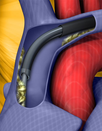 Imagen: Las plataformas de extracción de derivación mecánica TightRail y SightRail están diseñadas para la remoción segura de las derivaciones cardiacas (Fotografía cortesía de Spectranetics).