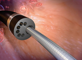 Imagen: El catéter de infusión ND multi-lúmen (Fotografía cortesía del Instituto de Investigación Traslacional).