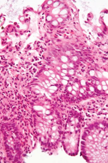 Imagen: Microfotografía de la inflamación del intestino grueso en un caso de enfermedad inflamatoria intestinal (Fotografía cortesía de Wikimedia Commons).