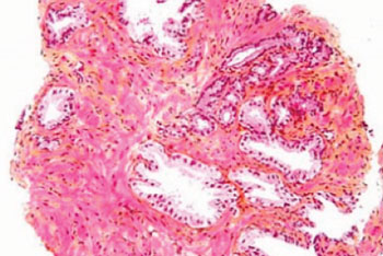 Imagen: Micrografía de glándulas prostáticas normales y otras con adenocarcinoma de próstata (parte superior derecha de la imagen) (Fotografía cortesía de Wikimedia Commons).