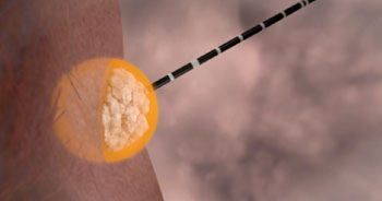 Imagen: La antena del sistema de ablación, Emprint, insertada en un tumor directamente a través de la piel (Fotografía cortesía de Covidien).