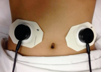 Imagen: El dispositivo acústico para la vigilancia gastrointestinal (AGIS) (Fotografía cortesía de la UCLA).