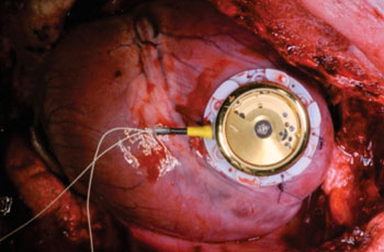 Imagen: Se muestra el dispositivo cosechador de energía suturado sobre el miocardio (Fotografía cortesía de Adrian Zurbuchen/Universidad de Berna).