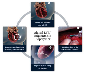 Imagen: El procedimiento para el implante de hidrogel Algisyl-LVR (Fotografía cortesía de LoneStar Heart).