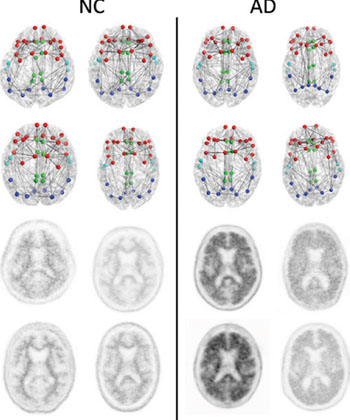 Imagen: Conectomas estructurales (dos hileras superiores) y las imágenes PET con florbetapir correspondientes (dos hileras inferiores) en cuatro pacientes con cognición normal (CN) con la carga más baja de amiloide en la corteza (izquierda) y los cuatro pacientes con EA con la carga más alta de amiloide en la corteza (derecha) enfocada en las regiones compuestas usadas en el conectoma versus el análisis de amiloide. Los nodos representan los centroides de las parcelaciones FreeSurfer en las regiones frontal (rojo) cingulada (verde), temporal (azul claro) y parietal (azul oscuto). Esto solo es un esquema que busca mostrar los conceptos y no busca mostrar ningún tipo de diferencia generalizable discernible visualmente entre los pacientes con CN y aquellos con EA. La métrica de la red estructural suministra información más sensible sobre el conectoma de las que son aparentes a través de la sola visualización (Fotografía cortesía de la RSNA). Imagen: Conectomas estructurales (dos hileras superiores) y las imágenes PET con florbetapir correspondientes (dos hileras inferiores) en cuatro pacientes con cognición normal (CN) con la carga más baja de amiloide en la corteza (izquierda) y los cuatro pacientes con EA con la carga más alta de amiloide en la corteza (derecha) enfocada en las regiones compuestas usadas en el conectoma versus el análisis de amiloide. Los nodos representan los centroides de las parcelaciones FreeSurfer en las regiones frontal (rojo) cingulada (verde), temporal (azul claro) y parietal (azul oscuto). Esto solo es un esquema que busca mostrar los conceptos y no busca mostrar ningún tipo de diferencia generalizable discernible visualmente entre los pacientes con CN y aquellos con EA. La métrica de la red estructural suministra información más sensible sobre el conectoma de las que son aparentes a través de la sola visualización (Fotografía cortesía de la RSNA).