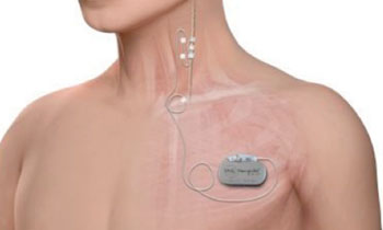 Imagen: Una ilustración del neuroestimulador VNS implantado (Fotografía cortesía de Cyberonics).
