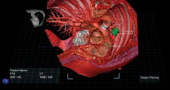 Imagen: Una composición de la anatomía de un paciente con el visualizador True3D (Fotografía cortesía de Echopixel).