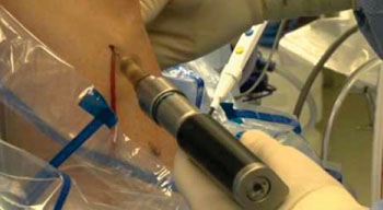 Imagen: El catéter Bio-MAC para aspiración de médula ósea, haciendo una extracción en la tibia (Fotografía cortesía de Biologic Therapies).