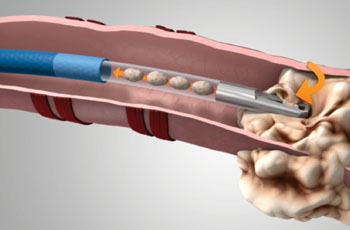Imagen: El sistema GenCut para biopsia de núcleos en el pulmón (Fotografía cortesía de Medtronic).
