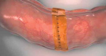 Imagen: El sellador quirúrgico Sylys colocado sobre una línea de grapas para una anastomosis (Fotografía cortesía de Cohera Medical).
