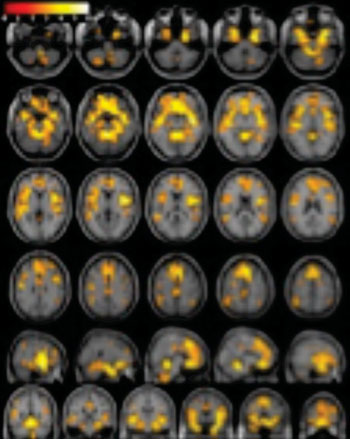 Imagen: Una imagen ponderada con RM en T1 de un cerebro, que muestra un volumen de materia gris significativamente mayor en los sujetos sanos de control que en las mujeres con dependencia a las drogas (Fotografía cortesía de la RSNA). Imagen: Una imagen ponderada con RM en T1 de un cerebro, que muestra un volumen de materia gris significativamente mayor en los sujetos sanos de control que en las mujeres con dependencia a las drogas (Fotografía cortesía de la RSNA).