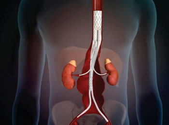 Imagen: El sistema para tratar TAAA con un stent desramificante (Fotografía cortesía de Sanford Health).
