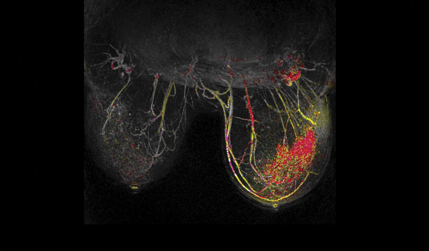 Imagen: Un mamografía para diagnóstico usando resonancia magnética con DWIBS, que muestra una lesión (Fotografía cortesía de DKFZ). Imagen: Un mamografía para diagnóstico usando resonancia magnética con DWIBS, que muestra una lesión (Fotografía cortesía de DKFZ).