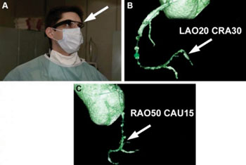 Imagen: Unas imágenes de CTA como aparecen en Google Glass (Fotografía cortesía de la revista Canadian Journal of Cardiology). Imagen: Unas imágenes de CTA como aparecen en Google Glass (Fotografía cortesía de la revista Canadian Journal of Cardiology).
