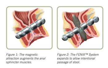 Imagen: El sistema de Incontinencia Fecal Fenix cerrado (L) y abierto (R) (Fotografía cortesía de Torax Medical).