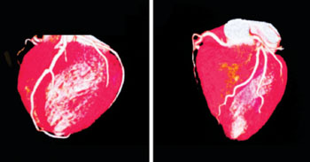 Imagen: Un examen en 3D del corazón de un niño que nació con defectos congénitos del corazón (Fotografía cortesía del Hospital para Niños de Phoenix).