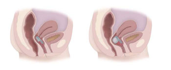 Imagen: El óvulo vaginal Eclipse en sus estados desinflado (Izquierda) e inflado (Derecha) (Fotografía cortesía de Pelvalon).