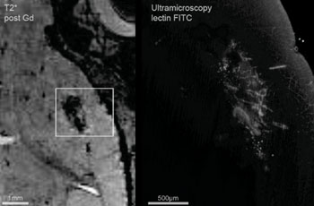 Imagen: Las imágenes de RM y de UM correlacionadas tres semanas después de la implantación del tumor GL261 (Fotografía cortesía de eLife). Imagen: Las imágenes de RM y de UM correlacionadas tres semanas después de la implantación del tumor GL261 (Fotografía cortesía de eLife).