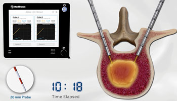 Imagen: El sistema para ablación OsteoCool RF (Fotografía cortesía de Medtronic).