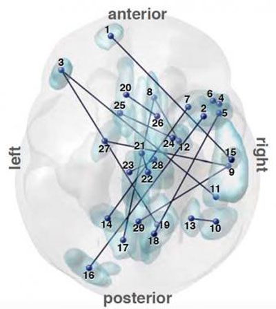 Imagen: Un mapa del cerebro ayuda a diferenciar a los pacientes diagnosticados con TEA (Fotografía cortesía de Nature Communications). Imagen: Un mapa del cerebro ayuda a diferenciar a los pacientes diagnosticados con TEA (Fotografía cortesía de Nature Communications).