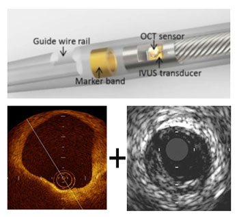 Imagen: El dispositivo IVUS-OCT puede capturar imágenes de infrarrojo y de ultrasonido y ayudar a encontrar la placa que podría causar un ataque al corazón o un derrame cerebral (Fotografía cortesía del Instituto Nacional de Imágenes Biomédicas y Bioingeniería de Estados Unidos). Imagen: El dispositivo IVUS-OCT puede capturar imágenes de infrarrojo y de ultrasonido y ayudar a encontrar la placa que podría causar un ataque al corazón o un derrame cerebral (Fotografía cortesía del Instituto Nacional de Imágenes Biomédicas y Bioingeniería de Estados Unidos).
