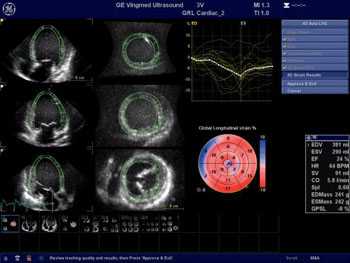 Imagen: Los investigadores han encontrado que la ecocardiografía de tensión podría predecir con exactitud qué pacientes son propensos a tener complicaciones a causa de la miocardiopatía hipertrófica (Fotografía cortesía de GE / JHU). Imagen: Los investigadores han encontrado que la ecocardiografía de tensión podría predecir con exactitud qué pacientes son propensos a tener complicaciones a causa de la miocardiopatía hipertrófica (Fotografía cortesía de GE / JHU).