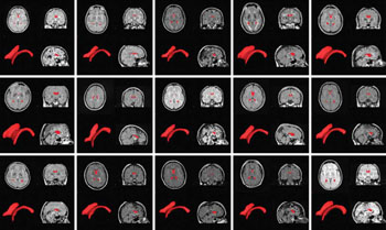 Imagen: Exámenes cerebrales de los pacientes con el VL resaltado en rojo (Fotografía cortesía de la Universidad de Buffalo).