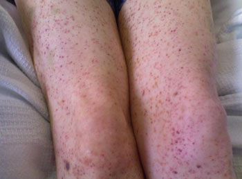 Imagen: La púrpura, un síntoma común de la trombocitopenia idiopática (Fotografía cortesía de purpurapictures.com).