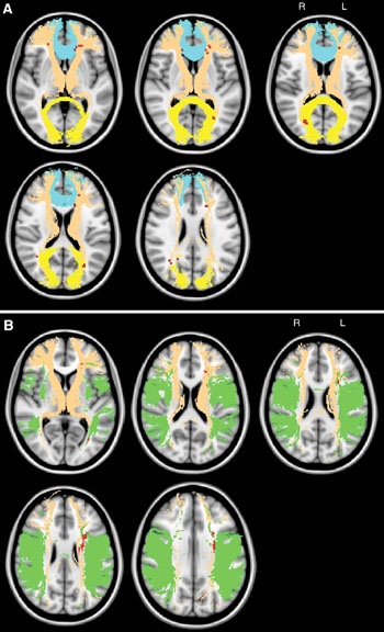 Imagen: La topografía de las lesiones isquémicas crónicas relacionadas con el deterioro cognitivo global (A), y la topografía de las lesiones isquémicas crónicas relacionadas con la fluidez alterada (B) (Fotografía cortesía de la RSNA). Imagen: La topografía de las lesiones isquémicas crónicas relacionadas con el deterioro cognitivo global (A), y la topografía de las lesiones isquémicas crónicas relacionadas con la fluidez alterada (B) (Fotografía cortesía de la RSNA).