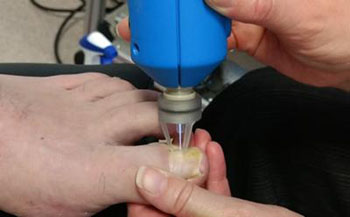 Imagen: El gas plasma atmosférico frío puede tratar infecciones comunes de las uñas (Fotografía cortesía de la universidad de Southampton).