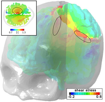 Imagen: Una simulación de una inflamación del 10% del cerebro, posterior a una craniectomía descompresiva (Fotografía cortesía de PRL).