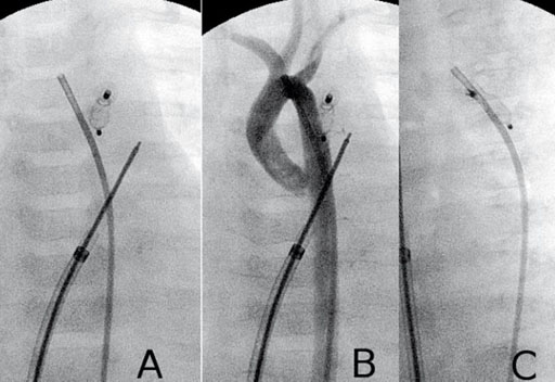 Imagen: Un cierre de un Ductus Arteriosus Patente (PDA) en un bebé (Fotografía cortesía del Instituto de Cardiología Cedars-Sinaí). Imagen: Un cierre de un Ductus Arteriosus Patente (PDA) en un bebé (Fotografía cortesía del Instituto de Cardiología Cedars-Sinaí).