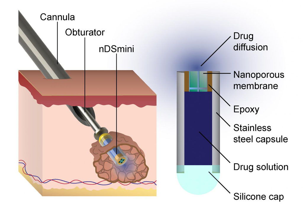 Imagen: Un diagrama de la cápsula y la implantación en un tumor canceroso (Fotografía cortesía de Lyle Hood/UTSA).