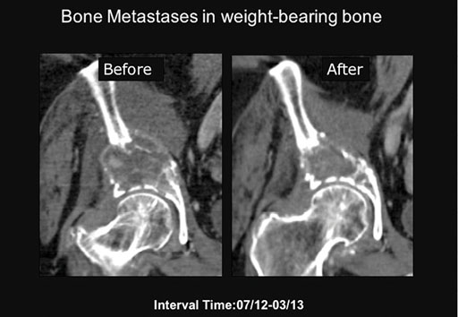 Imagen: Una TC antes del tratamiento y otra ocho meses después. Las imágenes demuestran que el tratamiento dio como resultado una mineralización, de novo, en el área objetivo y la restauración parcial del hueso cortical (Fotografía cortesía de la RSNA). Imagen: Una TC antes del tratamiento y otra ocho meses después. Las imágenes demuestran que el tratamiento dio como resultado una mineralización, de novo, en el área objetivo y la restauración parcial del hueso cortical (Fotografía cortesía de la RSNA).
