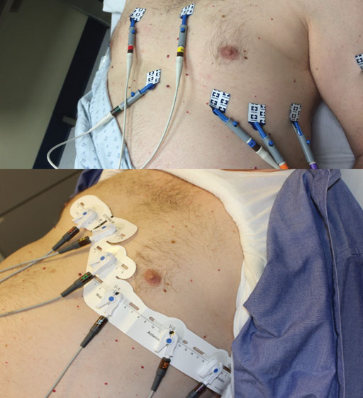 Imagen: El parche CardioQuick facilita la colocación correcta de los electrodos para el ECG (Fotografía cortesía de Ennovea Medical).