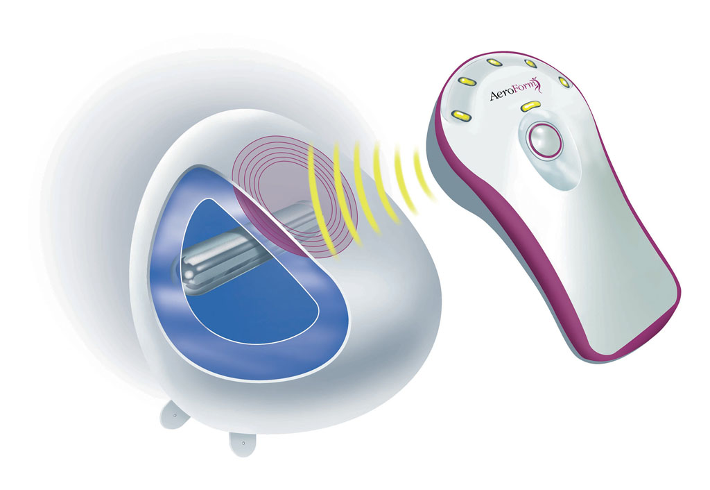 Imagen: Un sistema neumático utiliza CO2 comprimido para expandir el tejido mamario (Fotografía cortesía de AirXpanders).