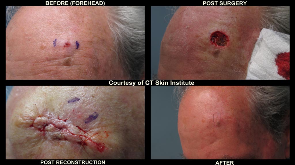 Imagen: Un ejemplo de MMS para el carcinoma basocelular (Fotografía cortesía del Instituto Dermatológico CT).