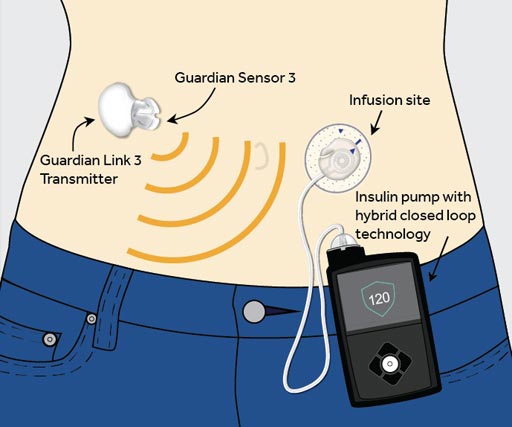 Imagen: Una ilustración del sistema de circuito cerrado híbrido MiniMed 670G (Fotografía cortesía de Medtronic).