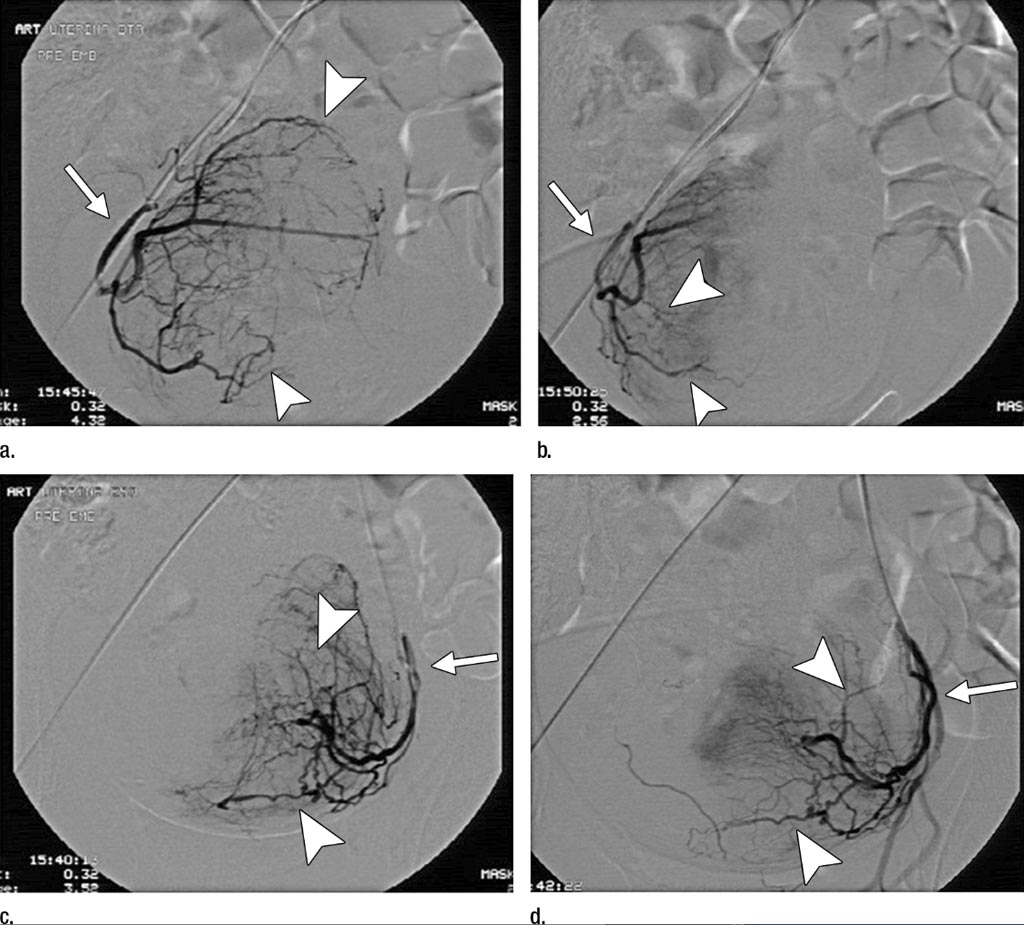 Imagen: Las imágenes de la angiografía de substracción digital muestran el progreso de los tratamientos parciales de la Embolización de los Fibromas Uterinos (UFE) (Fotografía cortesía de la RSNA). Imagen: Las imágenes de la angiografía de substracción digital muestran el progreso de los tratamientos parciales de la Embolización de los Fibromas Uterinos (UFE) (Fotografía cortesía de la RSNA).