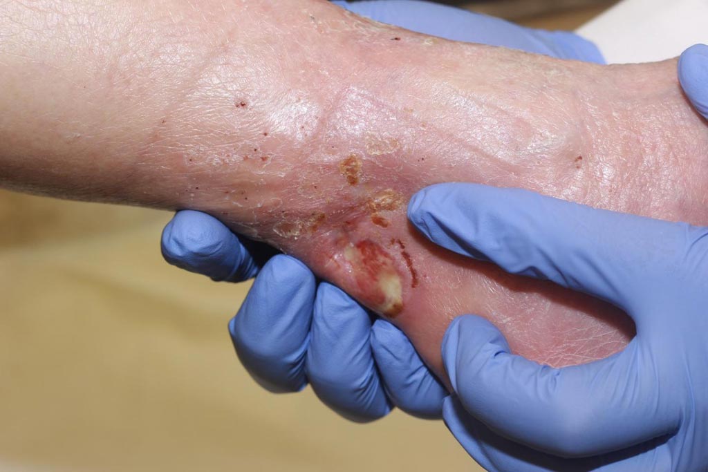 Imagen: Las heridas diabéticas crónicas podrían sanar rápidamente con un gel tópico de valsartan (Fotografía cortesía de JHU).