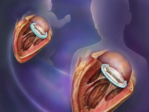 Imagen: Un nuevo estudio describe cómo un implante tubular trenzado podría crecer sincronizado con la válvula cardíaca de un niño (Fotografía cortesía de Randal McKenzie / BCH).