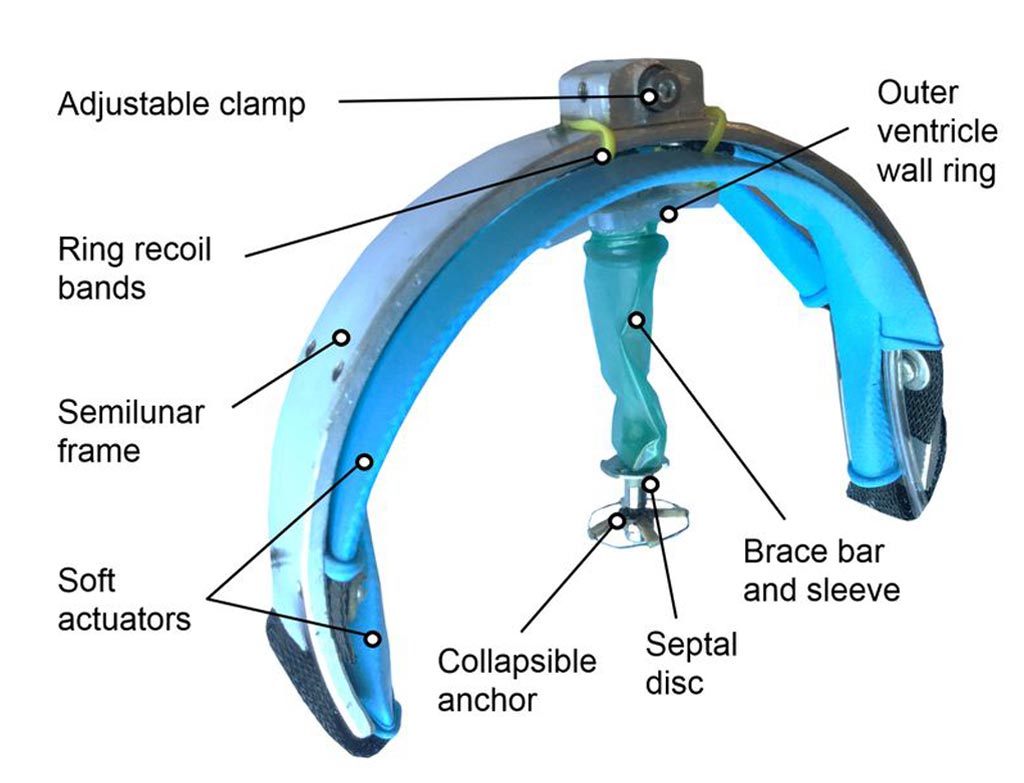 Imagen: Un nuevo estudio sugiere que un dispositivo robótico suave puede ayudar a un corazón en falla (Fotografía cortesía del Hospital de Niños de Boston).