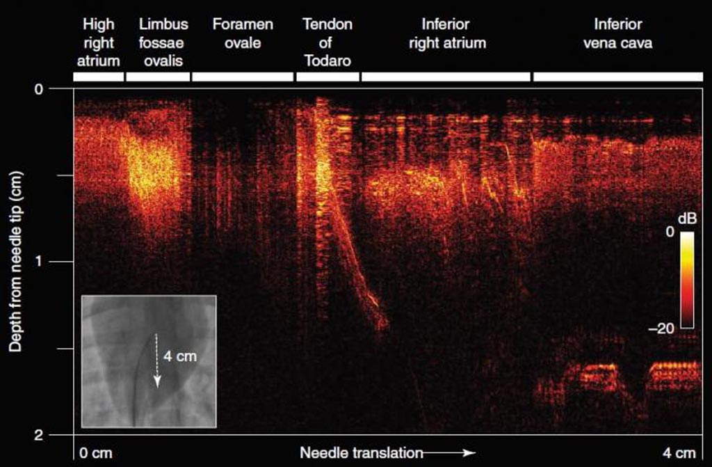 Imágenes de ultrasonido completamente ópticas adquiridas durante la traducción manual de la punta de la aguja a una distancia de cuatro centímetros. (Fotografía cortesía de Finlay et al).