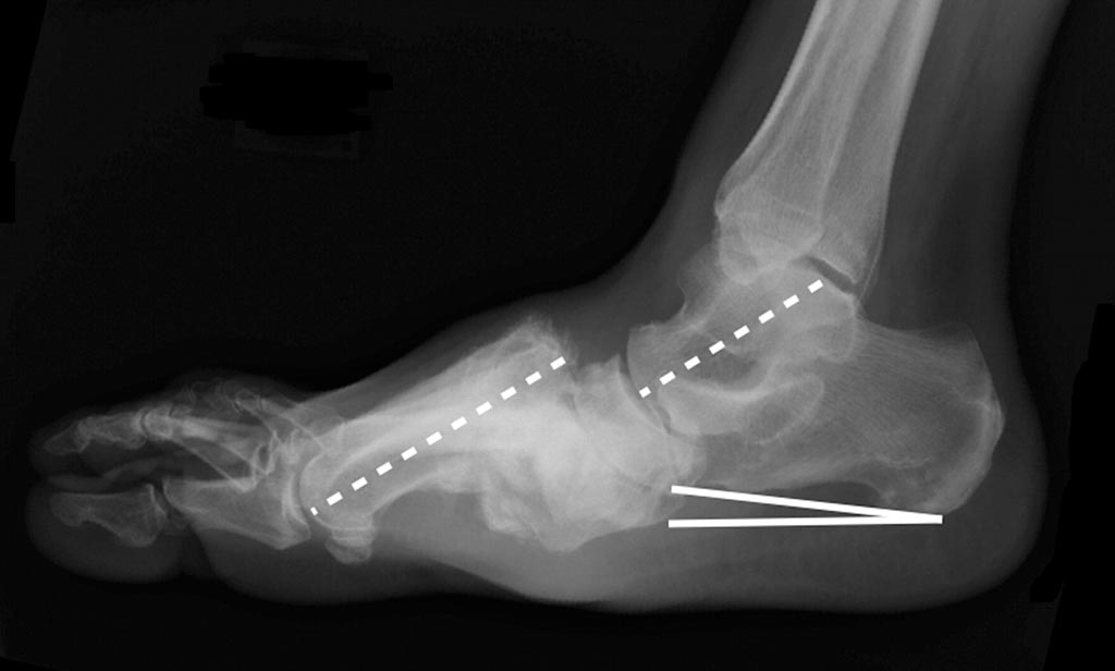 Imagen: Deformidad del pie de Charcot con dislocación de la articulación tarsometatarsiana (Fotografía cortesía de la Asociación Estadounidense de Diabetes).
