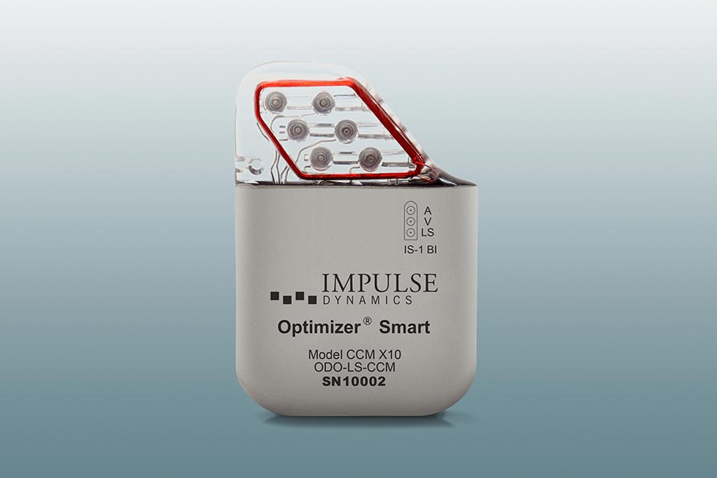 Imagen: El dispositivo implantable Impulse Dynamics Optimizer Smart (Fotografía cortesía de Impulse Dynamics).